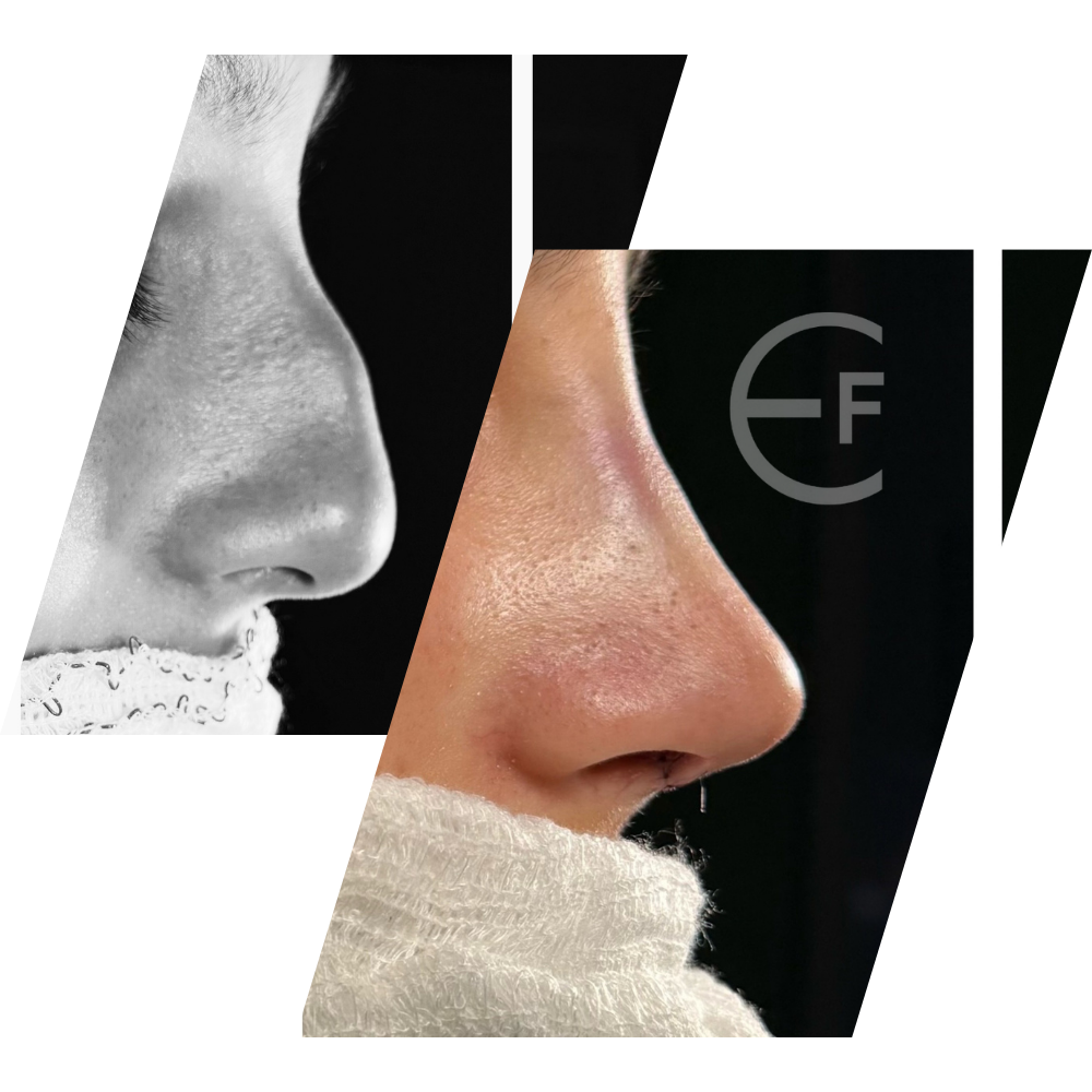 resultados rinoplastia dr edson freitas
